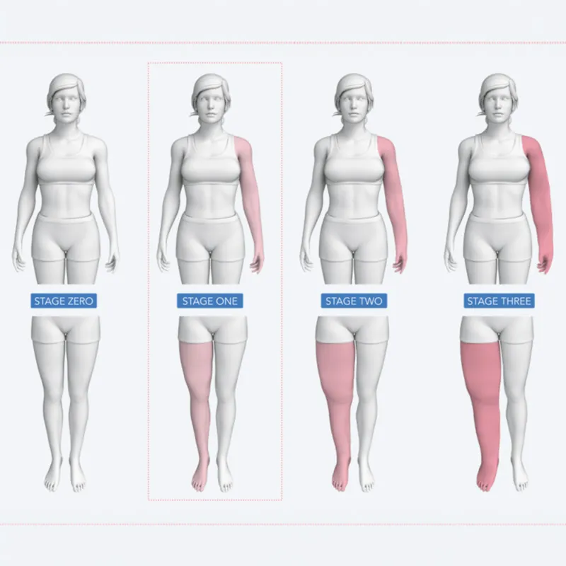 Lymphoedema